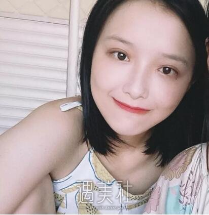 西安孙峰双眼皮案例分享|术后实时记录~
