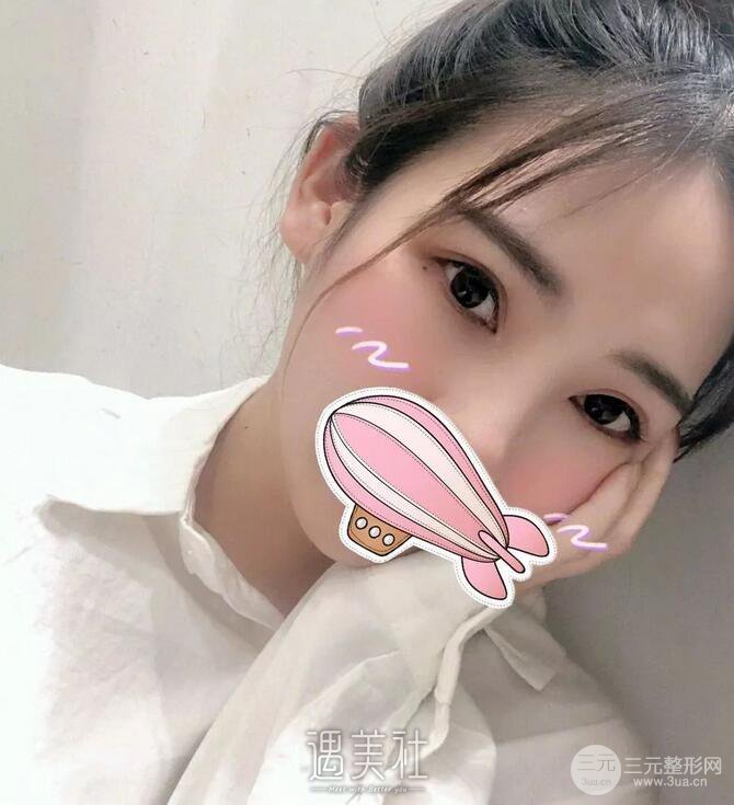 刘武林双眼皮案例分享，恢复全过程实时记录!