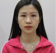 王琪影做的双眼皮果如何?有没有真实的案例分享? width=