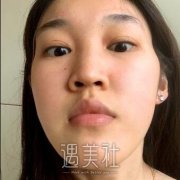邱立东脂肪填充案例：恢复果很不错哦~ width=
