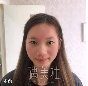 双眼皮,隆鼻