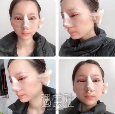双眼皮,隆鼻