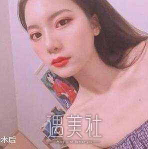 双眼皮,隆鼻