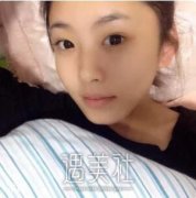 深圳林登文双眼皮案例：小眼逆袭大眼日记~ width=