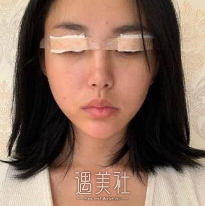 深圳,林登文,双眼皮
