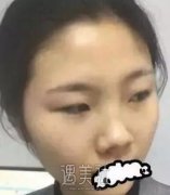 亚太程晓林做鼻子好吗？有真实案例给看看嘛？ width=