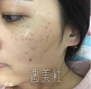 沈阳,陆军总院,光子嫩肤