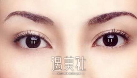 帕克双眼皮
