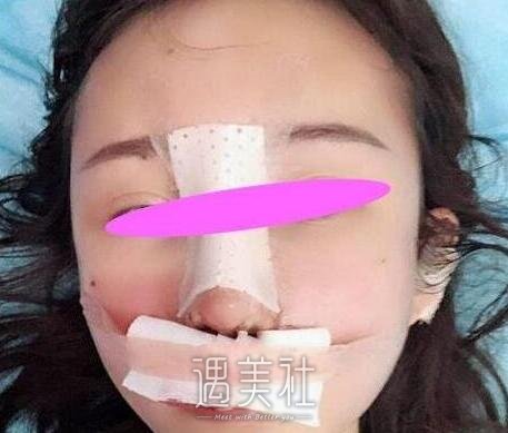上海,美立方,任天平,隆鼻