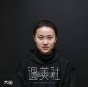 武汉郭晓东隆鼻案例:圆了我的主播梦 width=