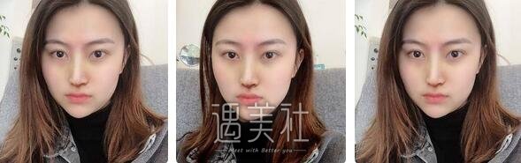 武汉,郭晓东,隆鼻