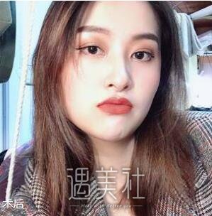武汉,郭晓东,隆鼻
