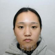 沧州中心医院美容科价目表：割双眼皮105天展现惊人变化~ width=