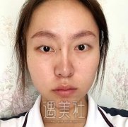 唐都医院整形科价目表：割双眼皮果前后对比分享~ width=