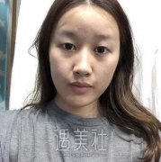 大同322医院割双眼皮前后对比案例：水灵灵大眼睛一秒变女神 width=