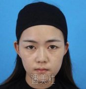 杭州艺之花整形医院价目表：杨海波鼻整形术前术后165天对比~ width=