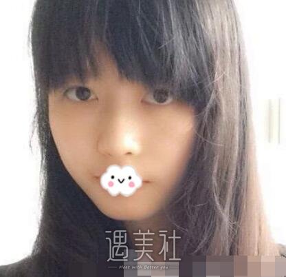 柳民熙,隆鼻