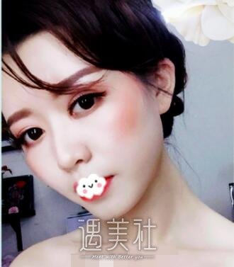 柳民熙,隆鼻