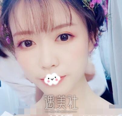 柳民熙,隆鼻