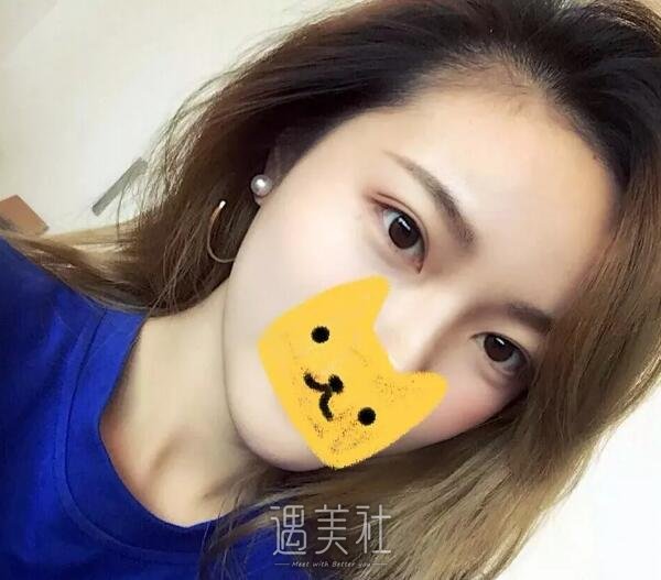 刘武林双眼皮案例分享，果较为自然真实!
