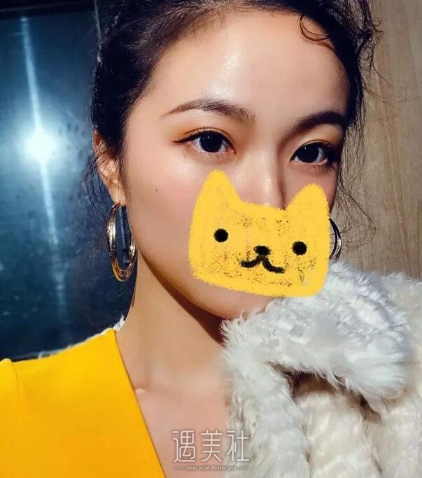 刘武林双眼皮案例分享，果较为自然真实!
