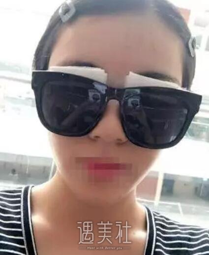 沈阳医大黄威做双眼皮怎么样?有真实的案例吗?