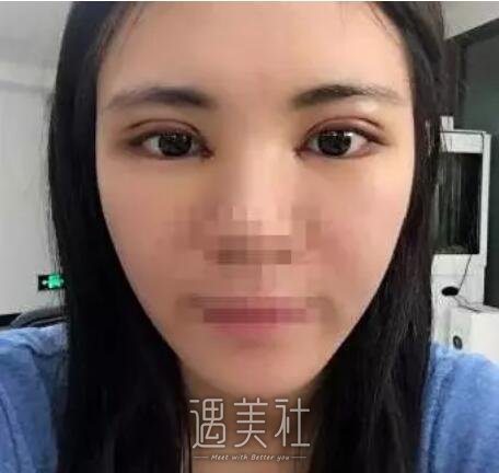 沈阳医大黄威做双眼皮怎么样?有真实的案例吗?