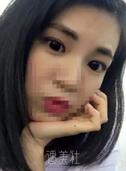 沈阳医大黄威做双眼皮怎么样?有真实的案例吗?