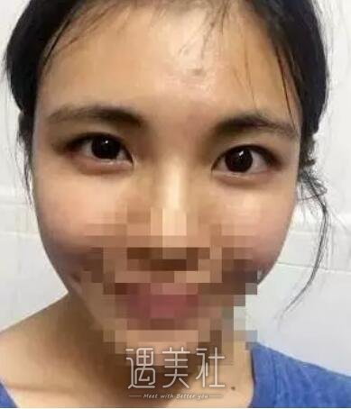 沈阳医大黄威做双眼皮怎么样?有真实的案例吗?