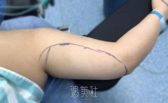 杭州静港程卫民吸脂技术好吗?能甩掉我这拜拜肉吗? width=