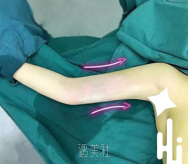 杭州静港程卫民吸脂技术好吗?能甩掉我这拜拜肉吗?