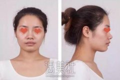 杭州维多利亚许凤芝案例展示，小翘鼻使我更! width=