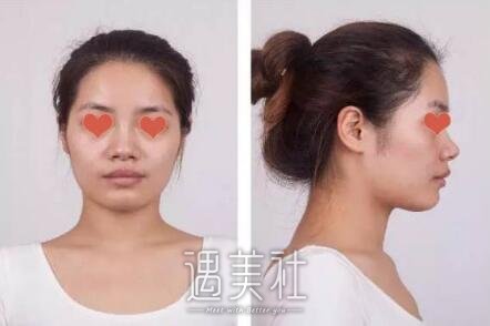 杭州维多利亚许凤芝案例展示，小翘鼻使我更!