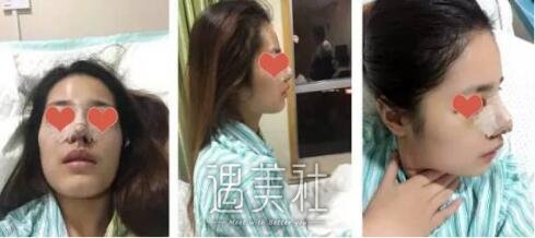 杭州维多利亚许凤芝案例展示，小翘鼻使我更!