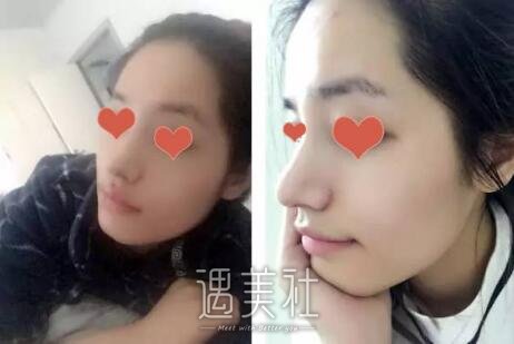 杭州维多利亚许凤芝案例展示，小翘鼻使我更!