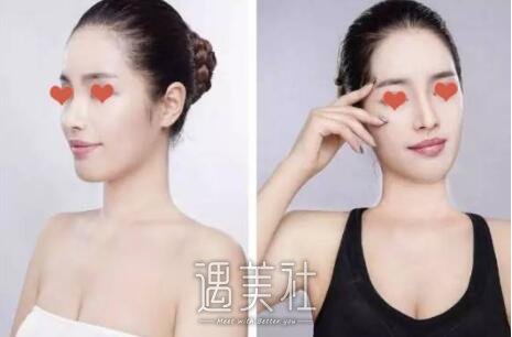 杭州维多利亚许凤芝案例展示，小翘鼻使我更!