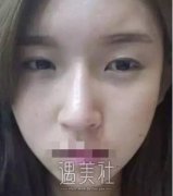 杭州维多利亚许凤芝双眼皮技术如何?真实案例一览~ width=