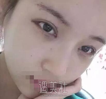 杭州维多利亚许凤芝双眼皮技术如何?真实案例一览~