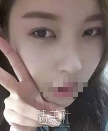 杭州维多利亚许凤芝双眼皮技术如何?真实案例一览~