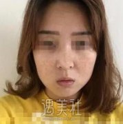 哈尔滨211医院激光祛斑实力如何?真实案例一览~ width=