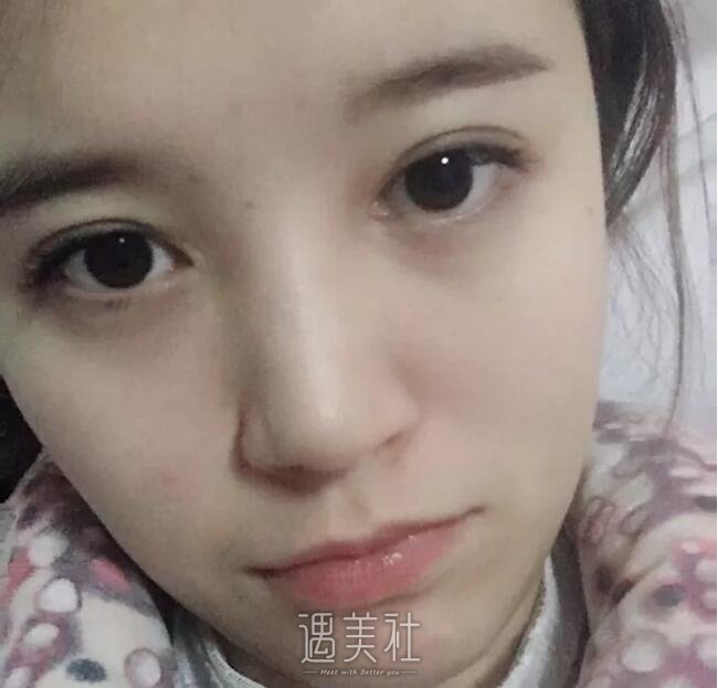 高柳进医生隆鼻案例流出|技术的完全诠释