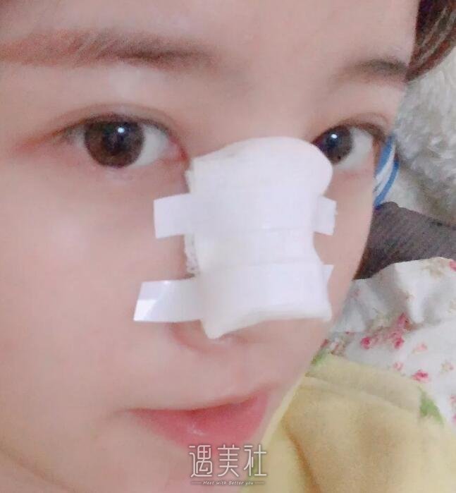 高柳进医生隆鼻案例流出|技术的完全诠释