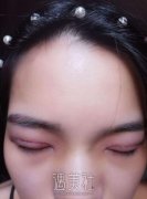 西京医院修复双眼皮的专家有靠谱的吗? width=