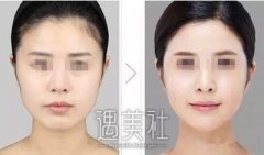 西京医院削骨手术多少钱? width=