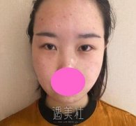 素美杨迪双眼皮案例图分享，很不错~ width=