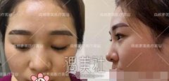成都素美杨迪割双眼皮+隆鼻真实经历曝光内附照片 width=