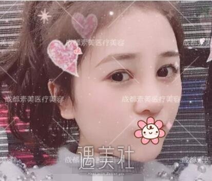 成都,素美,杨迪,割双眼皮,隆鼻