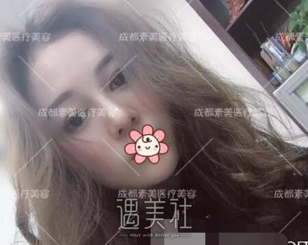 成都,素美,杨迪,割双眼皮,隆鼻
