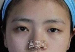 上海九院谢峰双眼皮案例 眼睛大了很多 width=