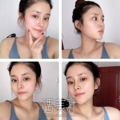 上海,百达丽,韩嘉毅,隆鼻